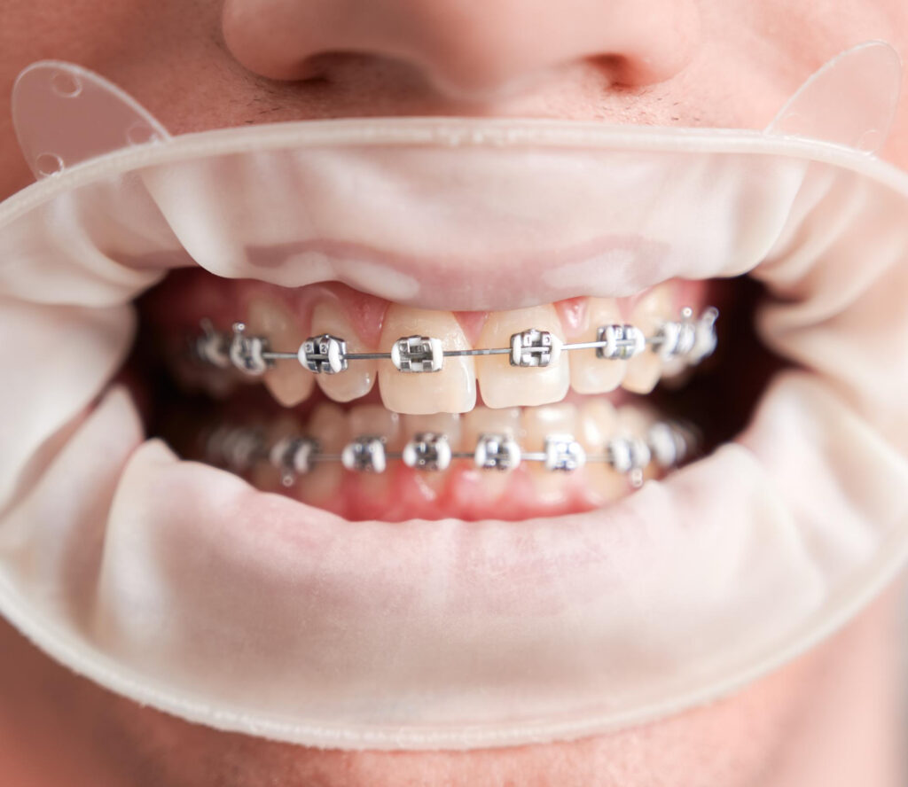 Self-Ligating Braces: Key Advantages Over Traditional Braces